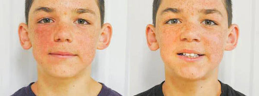 Side-by-side comparison of Hewitt face with and without redness